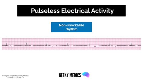 Shockable vs. Non-shockable Rhythms in Cardiac Arrest | Geeky Medics