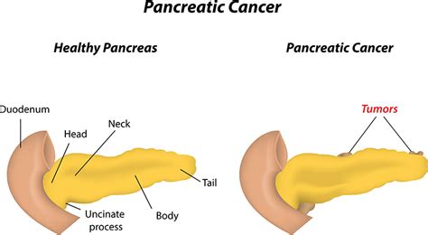 Pancreatic Cancer-Causes,Symptoms,Treatment in Bangalore