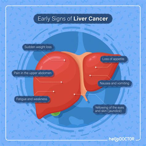 What Happens in Liver Cancer: All You Need To Know - Hello Doctor