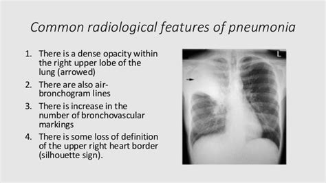 Radiological features of pneumonia