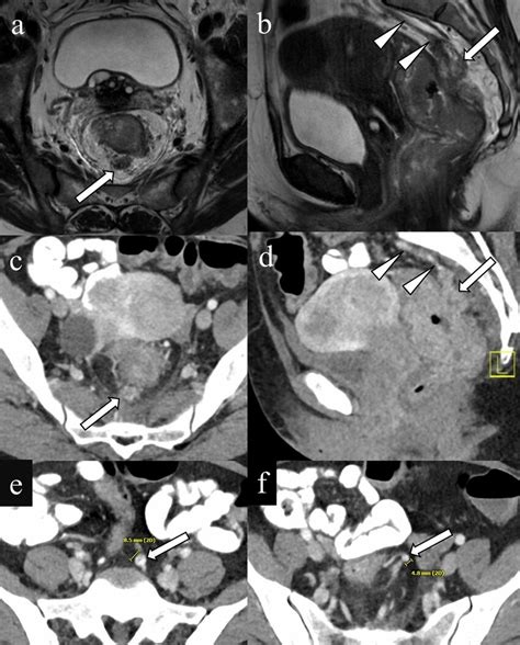 Extramural venous invasion on CT. A 47-year-old female with rectal ...