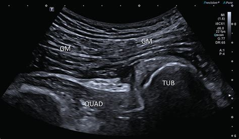 Hip Bursitis Ultrasound