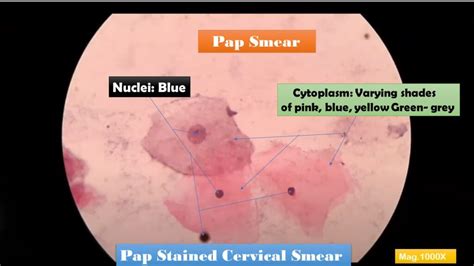 Pap Smear: Introduction, Principle, Staining Procedure, Result- Interpretat