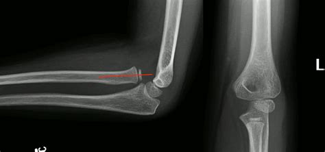 EMRad: Can’t Miss Pediatric Elbow Injuries | MED-TAC International Corp.