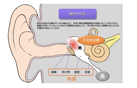 【速報】慢性中耳炎とは!? : ゆるふわ医書