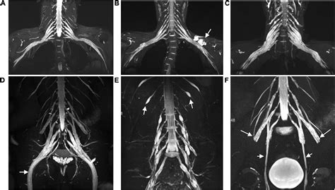 Frontiers | Multisequence Quantitative Magnetic Resonance Neurography of Brachial and ...