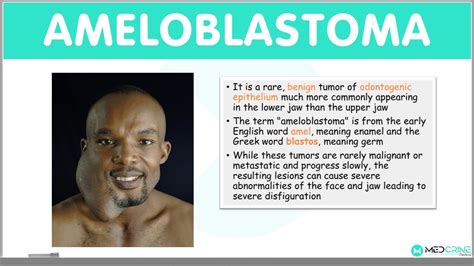 Ameloblastoma: Types, Clinical Features, Diagnosis, Differentials and ...