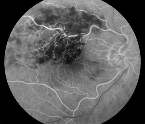 BRVO, Branch Retinal Vein Occlusion, BRVO Eye, BRVO Treatment