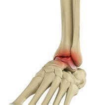 Ankle Arthritis Liverpool | Arthroscopic Ankle Surgery Liverpool