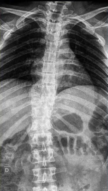 Thoracolumbar Fracture-Dislocation - Spine - Orthobullets