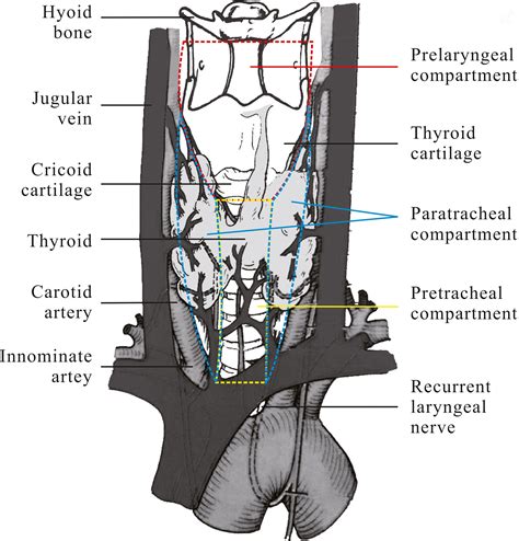 Risk factors for level V lymph node metastases in solitary papillary ...