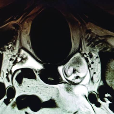 Pelvic MRI showing right ovarian dermoid cyst. | Download Scientific Diagram