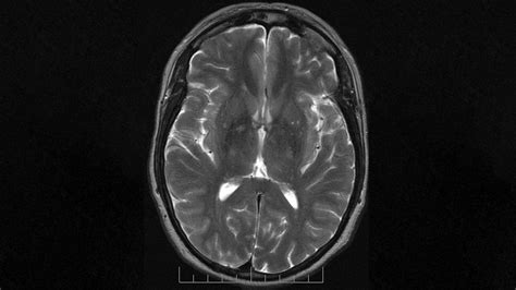 Mri Images Of The Brain