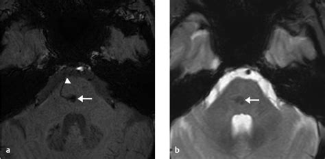 13 Brain Capillary Telangiectasias | Radiology Key