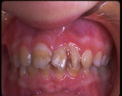 PowerPoint Presentation - DENTAL TRAUMATIC INJURIES