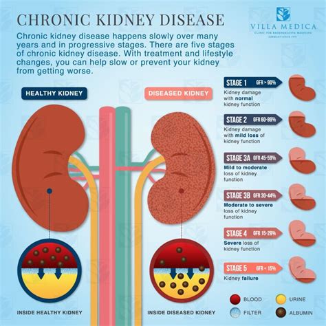 Villa Medica - Chronic Kidney Disease Explained - Infographic | Chronic kidney disease diet ...