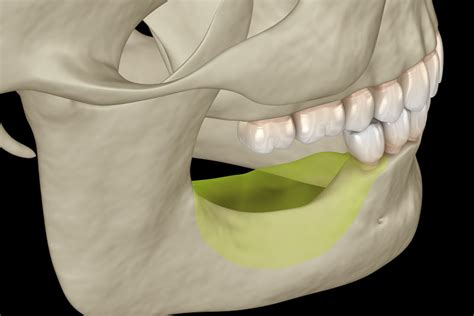 Severe Bone Loss Solutions in Long Beach, CA | Dr. Tim Silegy OMFS