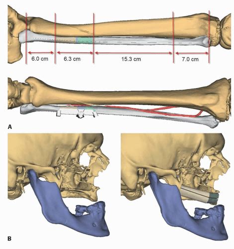 Free Fibula Flap for Midface Reconstruction | Plastic Surgery Key