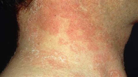 Is That Rash Psoriasis? Psoriasis Pictures and More | Everyday Health