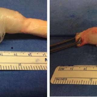 Two images demonstrating the propensity for the aorta to rupture in the ...