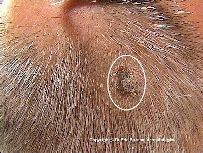 dermoscopy: Seborrheic keratosis (keratotic subtype)