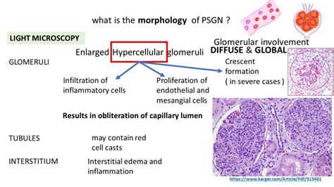 Acute Post Streptococcal Glomerulonephritis - Pathology Made Simple