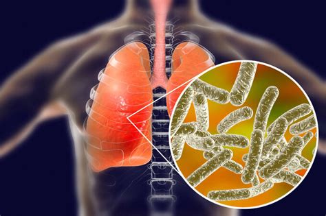 What Are The Symptoms Of Legionella? - Assessment Seekers