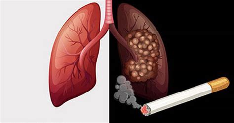 How does smoking cause lung cancer? | Vinmec