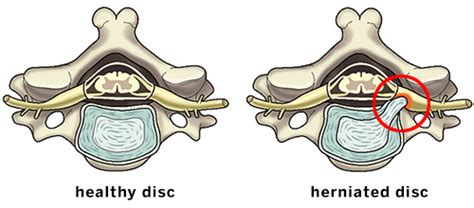 Herniated Disc (Ruptured or "Slipped" Spinal Disc) | HSS