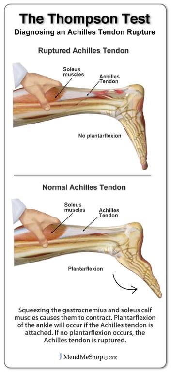 Tests and Methods for Achilles Tendonitis Diagnosis