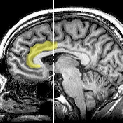 an MRI image highlighting the anterior cingulate cortex (ACC), where ...