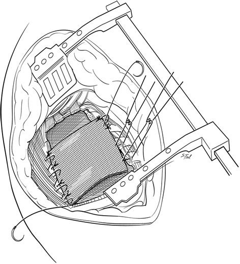 Chest wall reconstruction. After the specimens are removed, the chest ...