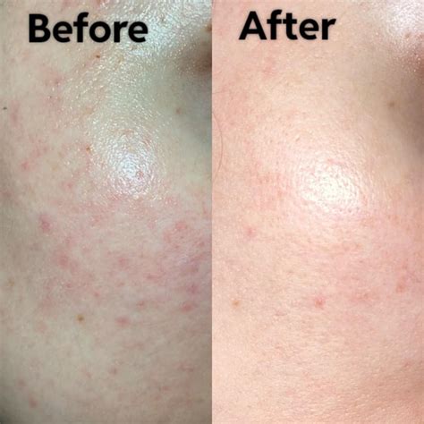 15% azelaic acid helped a lot : r/Rosacea