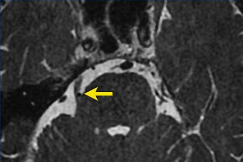 The Radiology Assistant : Trigeminal neuralgia (2023)