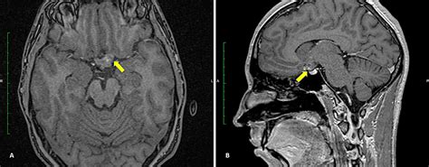 Cureus | Cavernous Hemangioma of the Chiasm and Left Optic Nerve