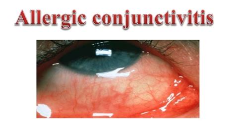 Allergic Conjunctivitis : Causes, Symptoms, Treatment and Prevention