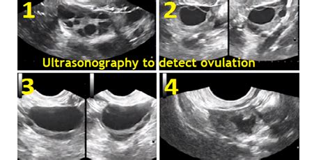 Ultrasound scanning of ovulation - Folliculometry (+ Photo ...