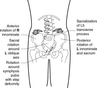 The malalignment syndrome: A synopsis | Musculoskeletal Key