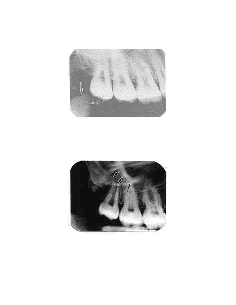 Coronoid Process of the Mandible. - Dental Radiography