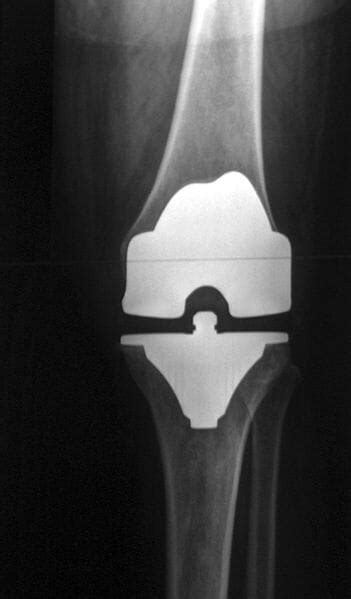 Prosthesis - Definition, Examples and Quiz | Biology Dictionary