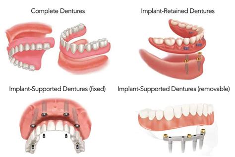 Frequently Asked Questions About Dental Implants and Implant Supported ...