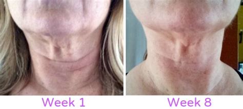 My Neck Firming Results – No Expensive Procedures