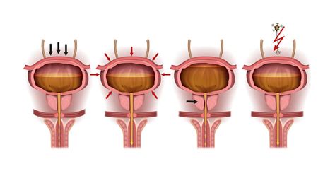 Overflow incontinence - symptoms - Wellspect