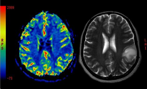 Perfusion Mri Imaging Of A Benign Brain Tumor Stock Photo - Download ...