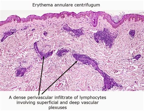 Dermatopathology Made Simple - Inflammatory: Spongiotic Reaction Pattern