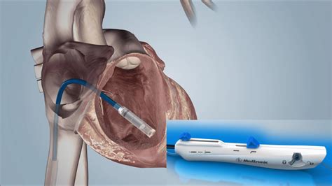 Leadless Pacemaker (PPM) Implantation - YouTube