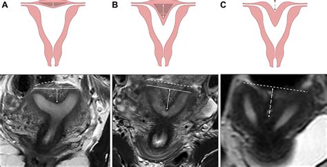 Müllerian Duct Anomalies: Role in Fertility and Pregnancy | RadioGraphics