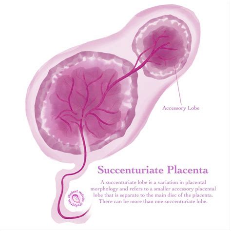 💕 Succenturiate Placenta 💕 ... - Student Midwife Studygram