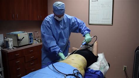 Liposuction with Downsize Lipo center - YouTube