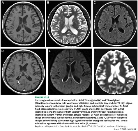 Cmv Retinitis Mri